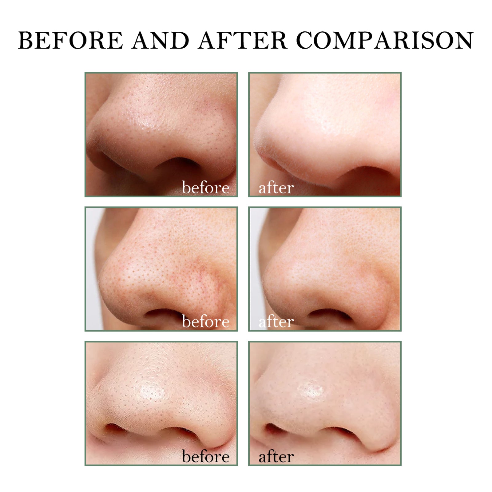 Blackhead Remover Kit — 15g Cream + 40 Pore Strips | Clear Smooth Skin — Prime Trend Market