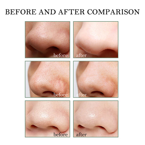 Blackhead Remover Kit — 15g Cream + 40 Pore Strips | Clear Smooth Skin — Prime Trend Market