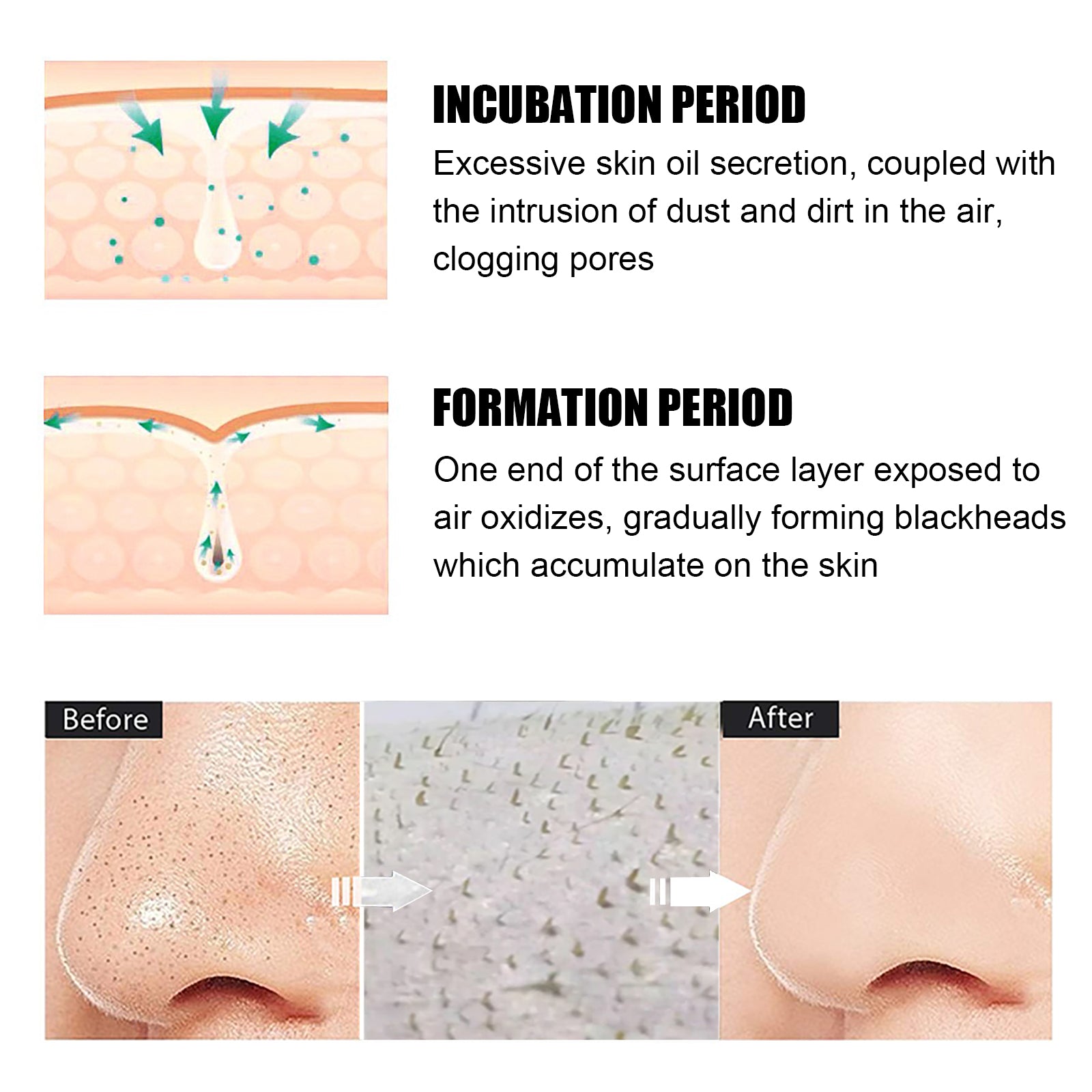 Blackhead Remover Kit — 15g Cream + 40 Pore Strips | Clear Smooth Skin — Prime Trend Market